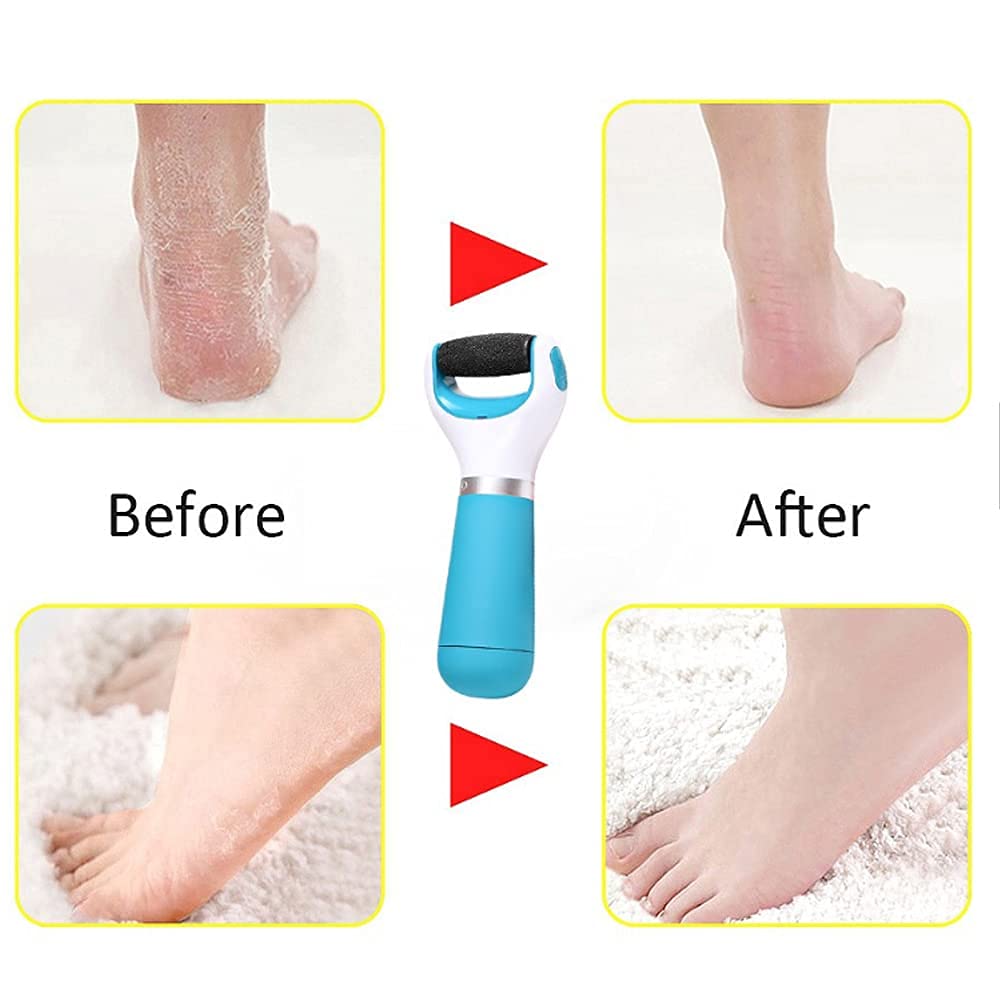 Pediflexy™️Foot Roller Callus Remover