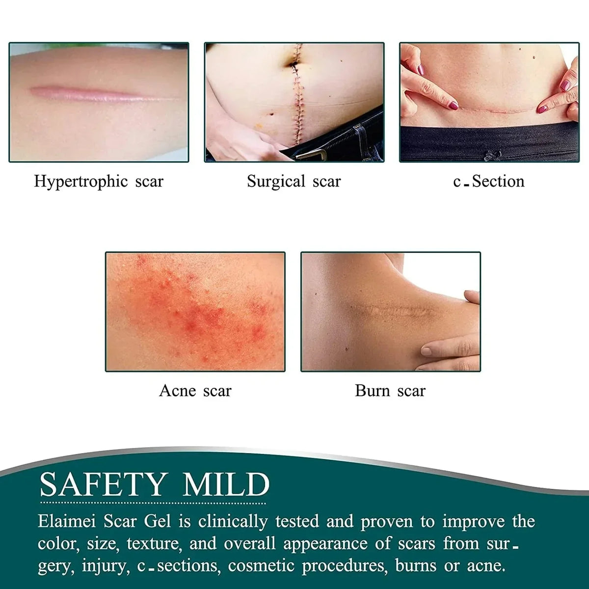 Dermoxy™ Scar Removal Tape